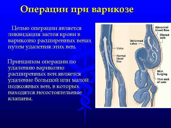 Варикоз Операция Отзывы Омск