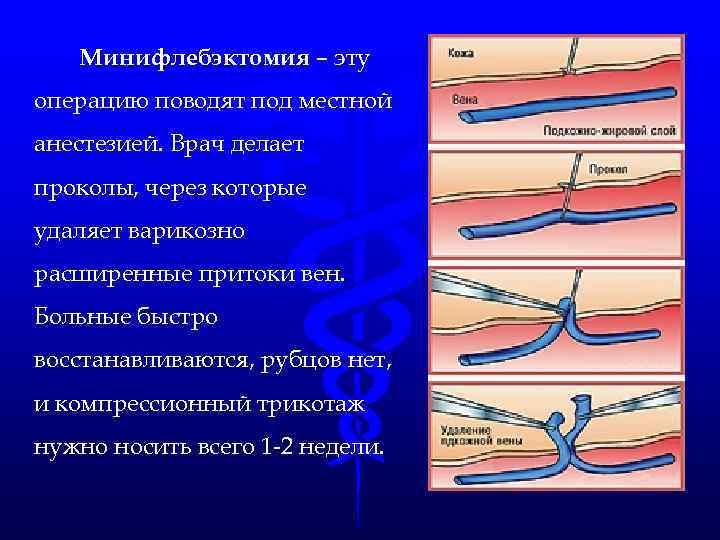 Варикоз Операция Последствия Форум