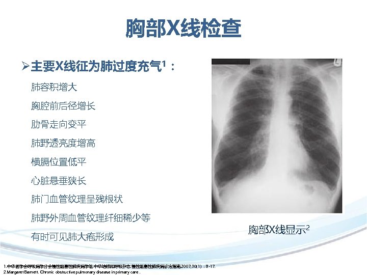 胸部x线检查 主要x线征为肺过度充气 1: 肺容积增大 胸腔前后径增长