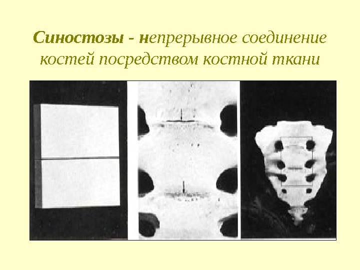 Синостозы - н епрерывное соединение костей посредством костной ткани 
