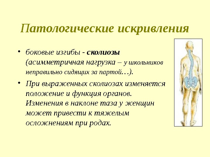 П атологические искривления • боковые изгибы - сколиозы  (асимметричная нагрузка – у школьников