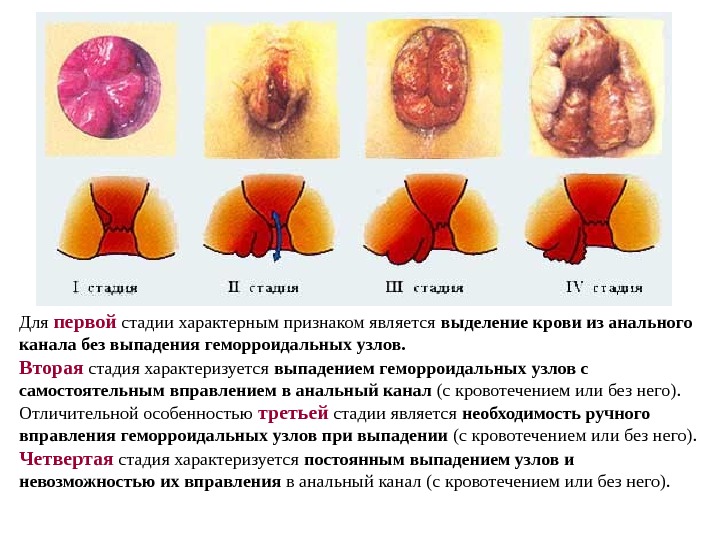 Для первой стадии характерным признаком является выделение крови из анального канала без выпадения геморроидальных