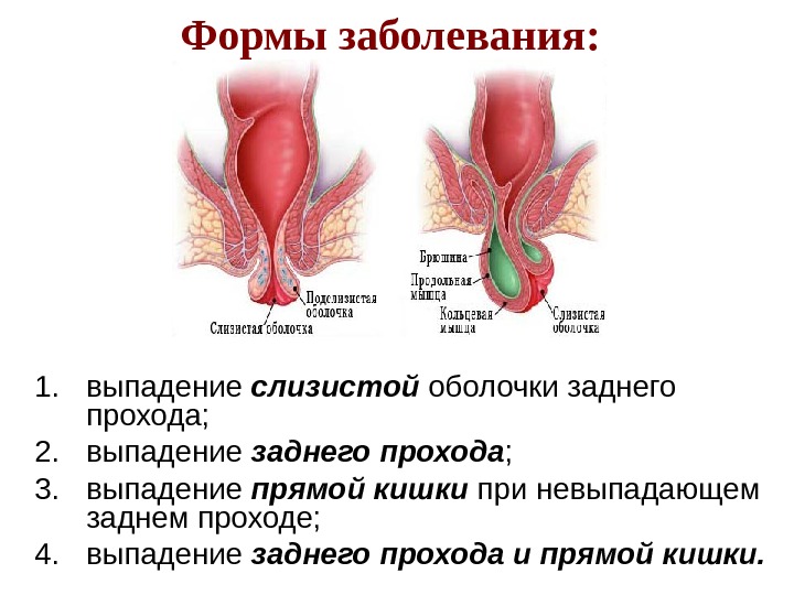 Формы заболевания:  1. выпадение слизистой оболочки заднего прохода; 2. выпадение заднего прохода ;