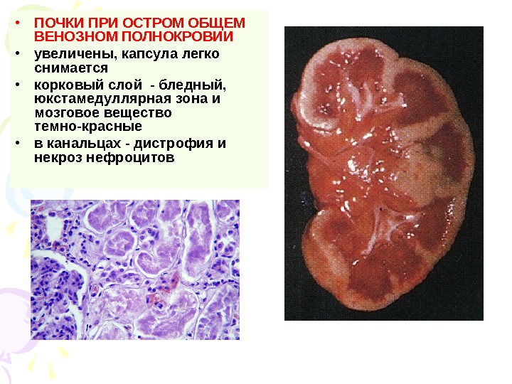   • ПОЧКИ ПРИ ОСТРОМ ОБЩЕМ ВЕНОЗНОМ ПОЛНОКРОВИИ • увеличены, капсула легко снимается