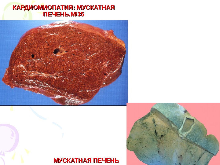   КАРДИОМИОПАТИЯ: МУСКАТНАЯ ПЕЧЕНЬ. М/35 МУСКАТНАЯ ПЕЧЕНЬ  