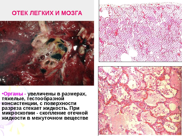   ОТЕК ЛЕГКИХ И МОЗГА • Органы - увеличены в размерах,  тяжелые,