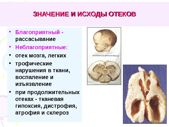   ЗНАЧЕНИЕ И ИСХОДЫ ОТЕКОВ • Благоприятный - рассасывание • Неблагоприятные: • отек