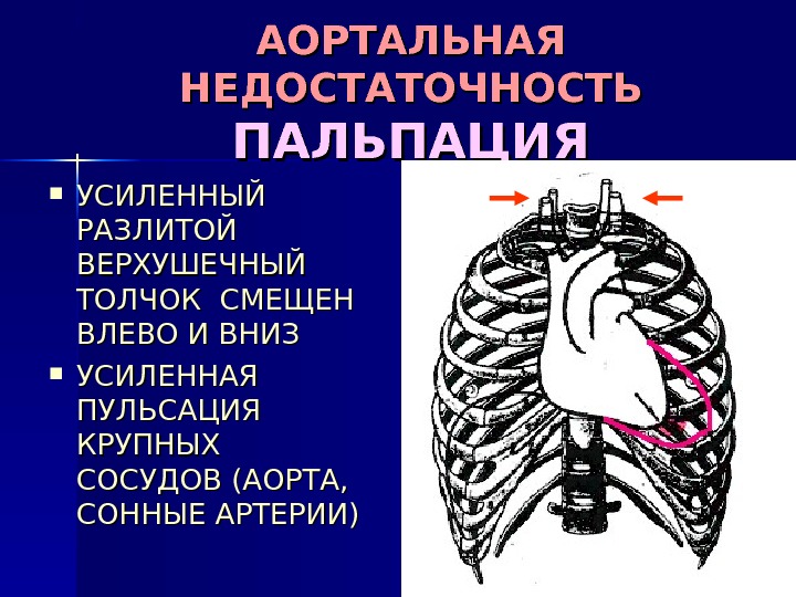 АОРТАЛЬНАЯ НЕДОСТАТОЧНОСТЬ ПАЛЬПАЦИЯ УСИЛЕННЫЙ РАЗЛИТОЙ ВЕРХУШЕЧНЫЙ ТОЛЧОК СМЕЩЕН ВЛЕВО ИВНИЗ УСИЛЕННАЯ ПУЛЬСАЦИЯ КРУПНЫХ СОСУДОВ