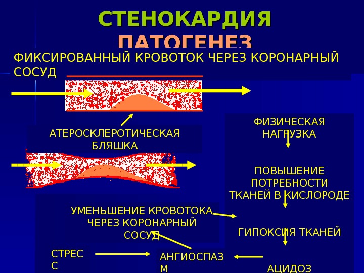 СТЕНОКАРДИЯ ПАТОГЕНЕЗ ФИКСИРОВАННЫЙ КРОВОТОК ЧЕРЕЗ КОРОНАРНЫЙ СОСУД ФИЗИЧЕСКАЯ НАГРУЗКА ПОВЫШЕНИЕ ПОТРЕБНОСТИ ТКАНЕЙ В КИСЛОРОДЕ