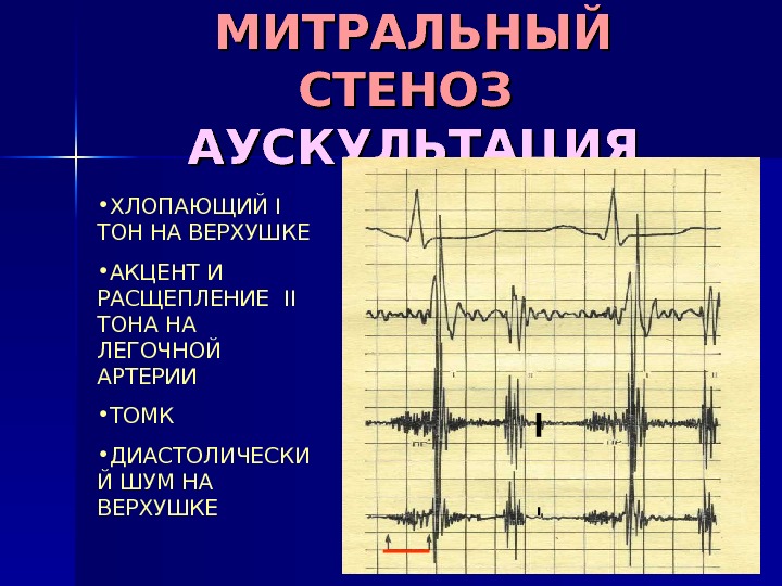 МИТРАЛЬНЫЙ СТЕНОЗ  АУСКУЛЬТАЦИЯ • ХЛОПАЮЩИЙ I  ТОН НА ВЕРХУШКЕ • АКЦЕНТ И