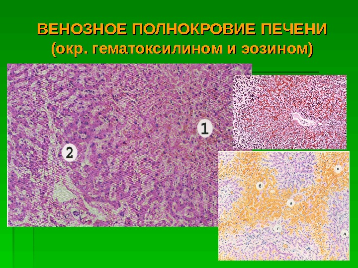   ВЕНОЗНОЕ ПОЛНОКРОВИЕ ПЕЧЕНИ (окр. гематоксилином и эозином)  