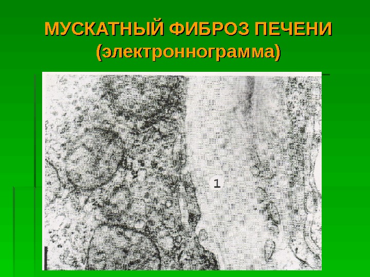   МУСКАТНЫЙ ФИБРОЗ ПЕЧЕНИ (электроннограмма)  