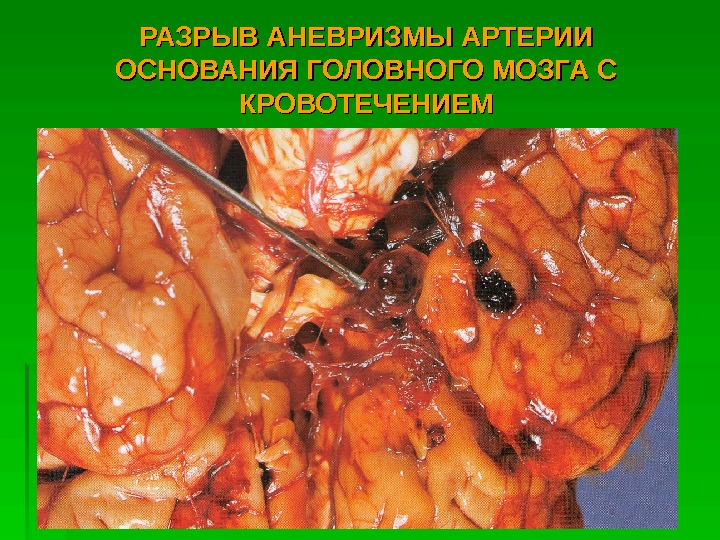   РАЗРЫВ АНЕВРИЗМЫ АРТЕРИИ ОСНОВАНИЯ ГОЛОВНОГО МОЗГА С КРОВОТЕЧЕНИЕМ  