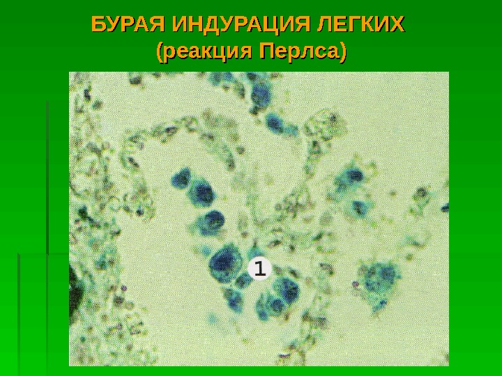   БУРАЯ ИНДУРАЦИЯ ЛЕГКИХ (реакция Перлса)  