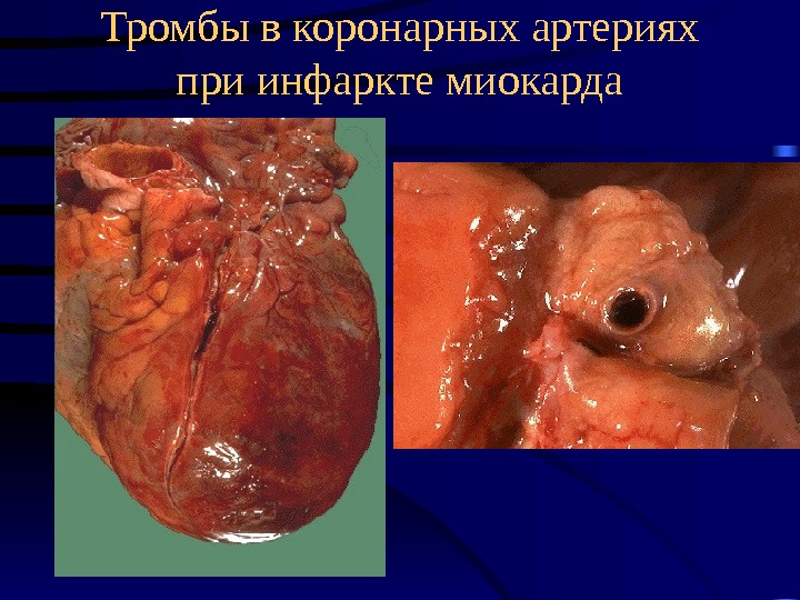   Тромбы в коронарных артериях при инфаркте миокарда 