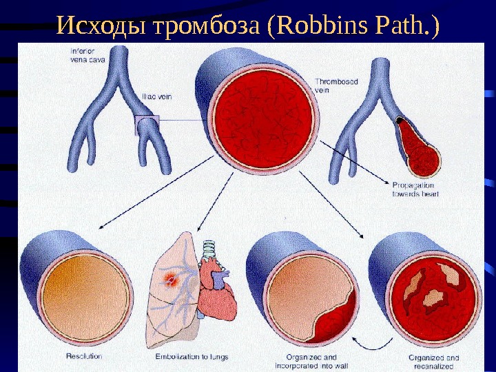   Исходы тромбоза ( Robbins Path. ) 