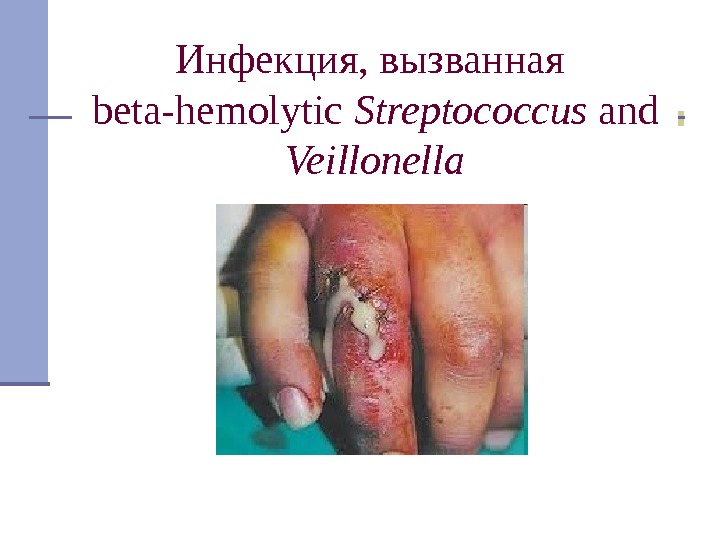 Инфекция, вызванная beta-hemolytic Streptococcus and Veillonella 