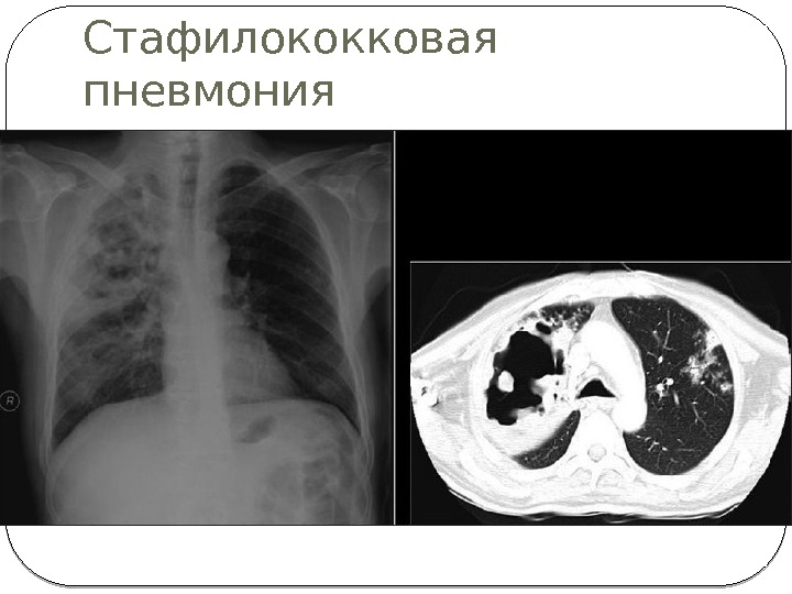 Стафилококковая пневмония 
