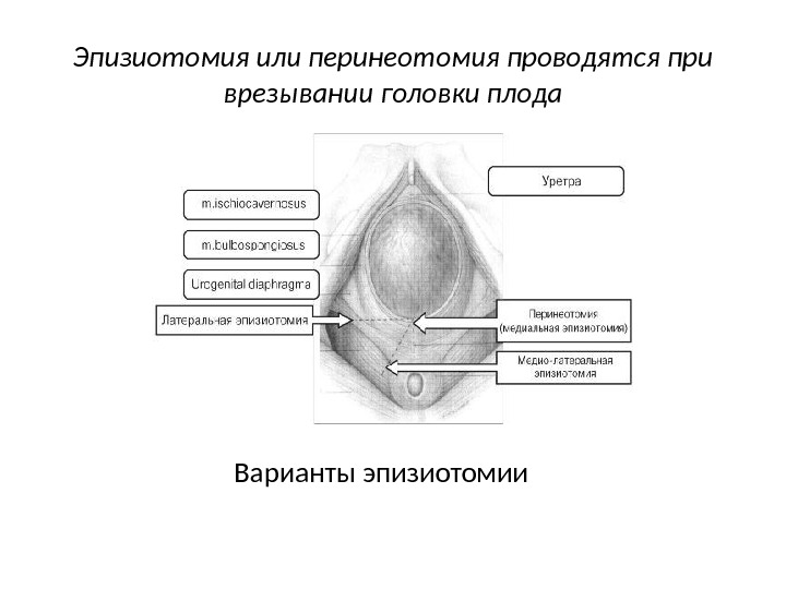 Эпизиотомия или перинеотомия проводятся при врезывании головки плода Варианты эпизиотомии 