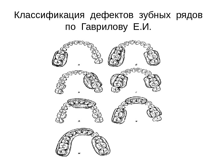 Классификация дефектов зубных рядов по Гаврилову Е. И. 