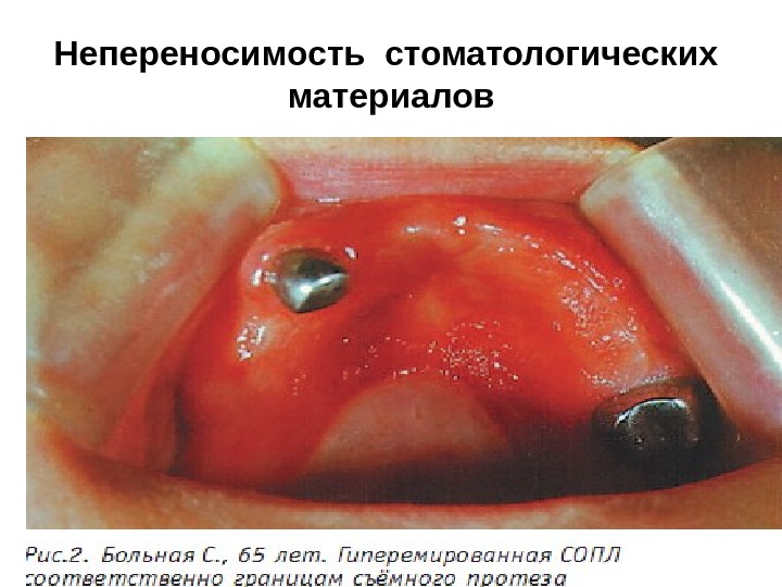 Непереносимость стоматологических  материалов 