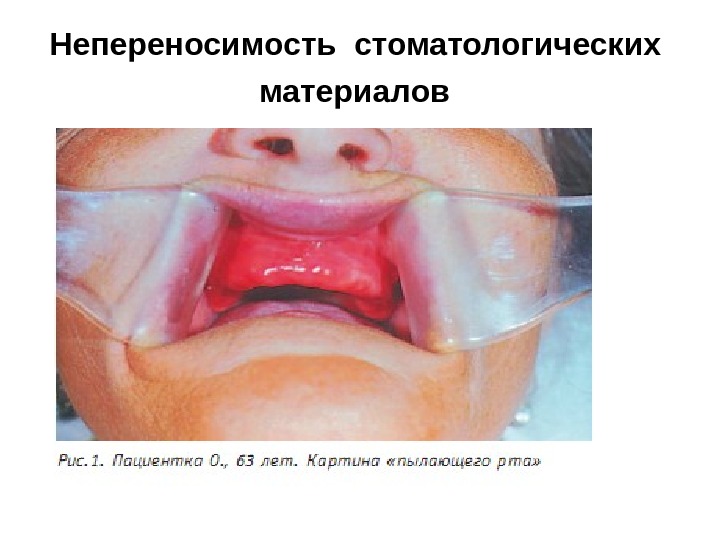Непереносимость стоматологических  материалов  