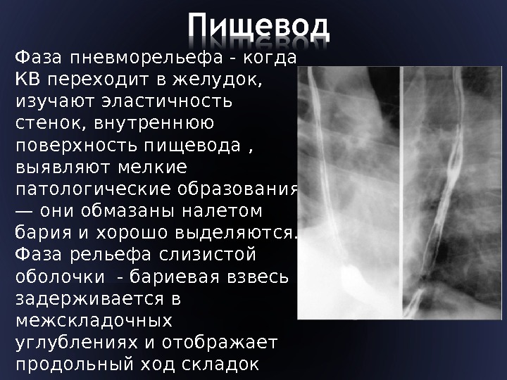 Фаза пневморельефа - когда КВ переходит в желудок,  изучают эластичность стенок, внутреннюю поверхность