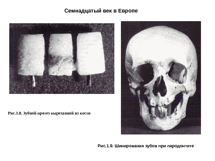 Семнадцатый век в Европе  Рис. 1. 8. Зубной протез вырезанной из кости Рис.