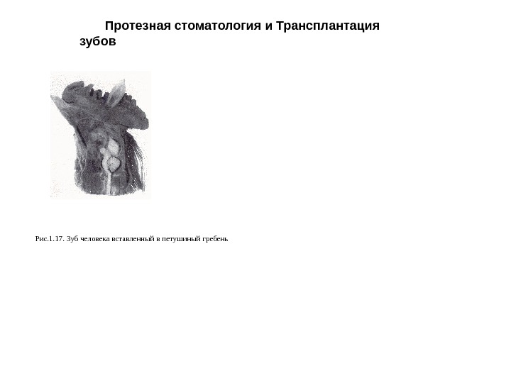 Протезная стоматология и Трансплантация зубов Рис. 1. 17. Зуб человека вставленный в петушиный гребень