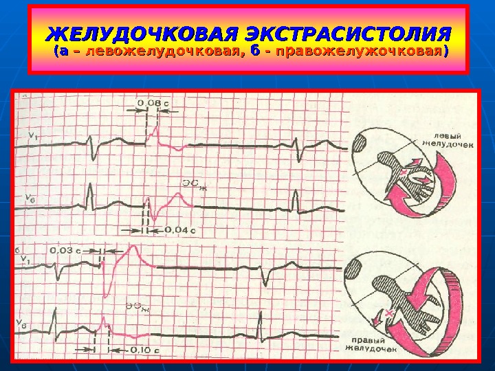   ЖЕЛУДОЧКОВАЯ ЭКСТРАСИСТОЛИЯ  (а(а – левожелудочковая,  бб - правожелужочковая )) 