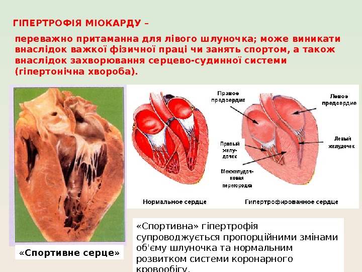 «Спортивне серце» ГІПЕРТРОФІЯ МІОКАРДУ – переважно притаманна для лівого шлуночка; може виникати внаслідок