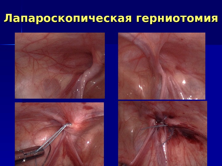 Лапароскопическая герниотомия 