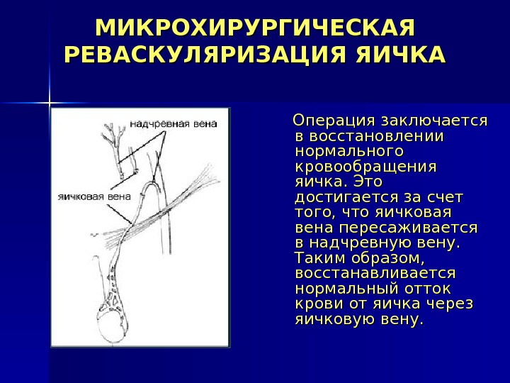 МИКРОХИРУРГИЧЕСКАЯ РЕВАСКУЛЯРИЗАЦИЯ ЯИЧКА  Операция заключается в восстановлении нормального кровообращения яичка. Это достигается за