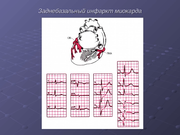   Заднебазальный инфаркт миокарда 