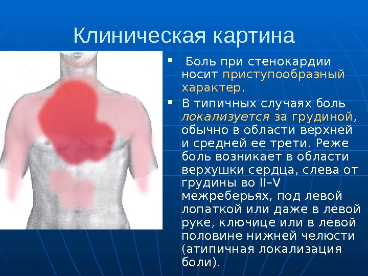  Клиническая картина Боль при стенокардии носит приступообразный характер.  Втипичных случаях боль локализуется