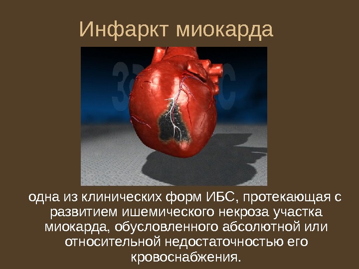 Инфаркт миокарда одна из клинических форм ИБС, протекающая с развитием ишемического некроза участка миокарда,