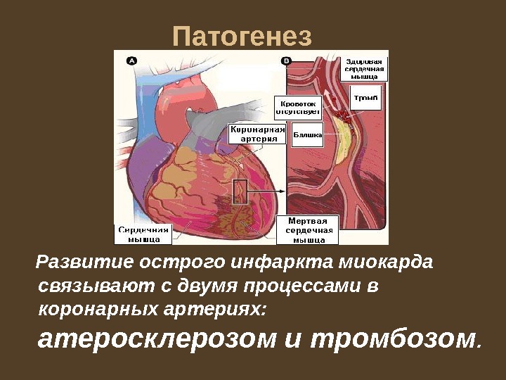 Патогенез  Развитие острого инфаркта миокарда связывают с двумя процессами в коронарных артериях: 
