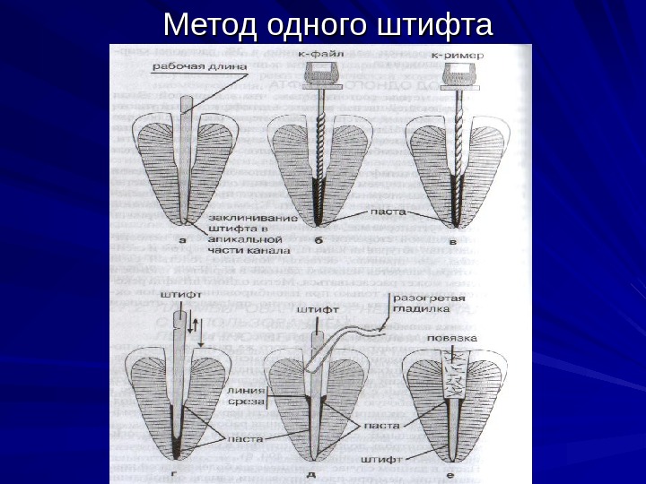 Метод одного штифта 