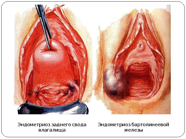  Эндометриоз заднего свода влагалища  Эндометриоз бартолинеевой железы 