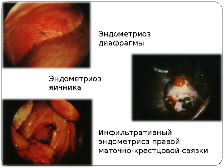 Эндометриоз диафрагмы Эндометриоз яичника Инфильтративный эндометриоз правой маточно-крестцовой связки 