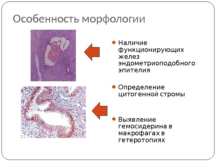 Особенность морфологии  Наличие  функционирующих  желез  эндометриоподобного эпителия  Определение 