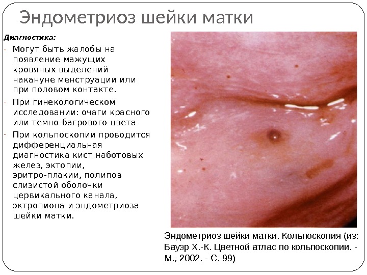 Эндометриоз шейки матки Диагностика:  - Могут быть жалобы на появление мажущих кровяных выделений