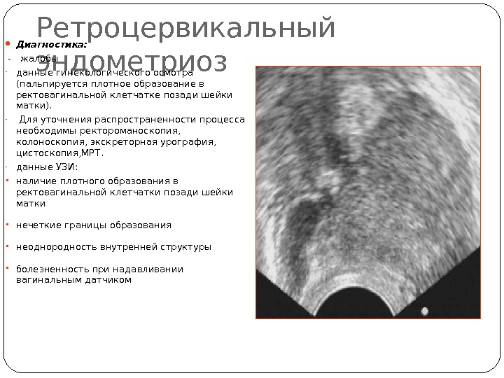 Ретроцервикальный эндометриоз Диагностика:  -  жалобы - данные гинекологического осмотра (пальпируется плотное образование