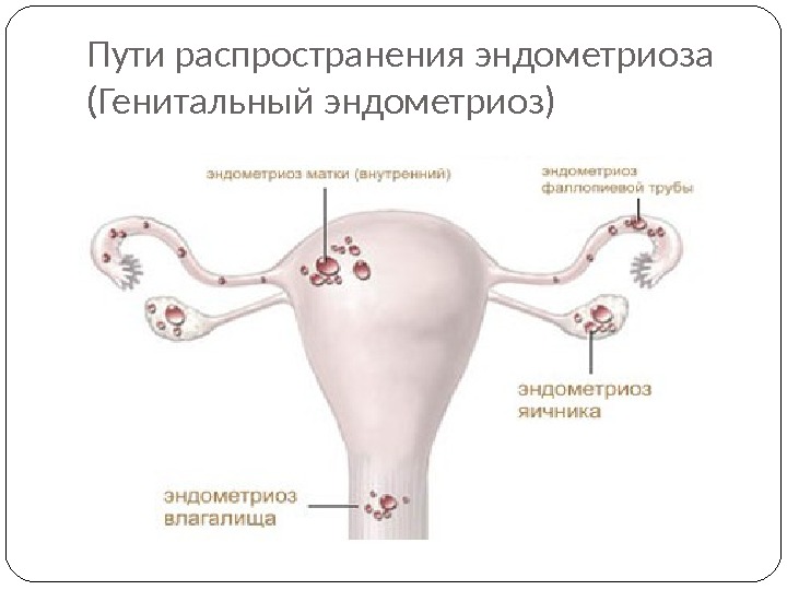 Пути распространения эндометриоза (Генитальный эндометриоз) 