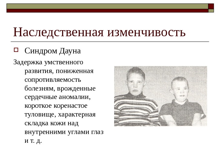 Наследственная изменчивость Синдром Дауна Задержка умственного развития, пониженная сопротивляемость болезням, врожденные сердечные аномалии, 