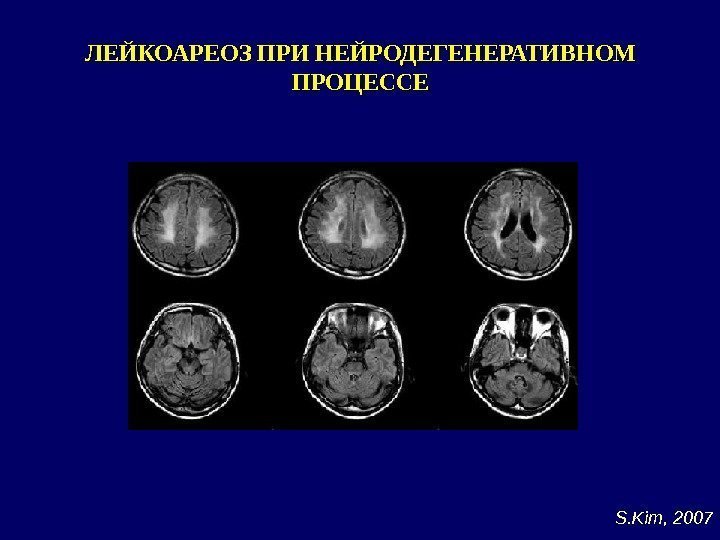 ЛЕЙКОАРЕОЗ ПРИ НЕЙРОДЕГЕНЕРАТИВНОМ ПРОЦЕССЕ S. Kim, 2007 