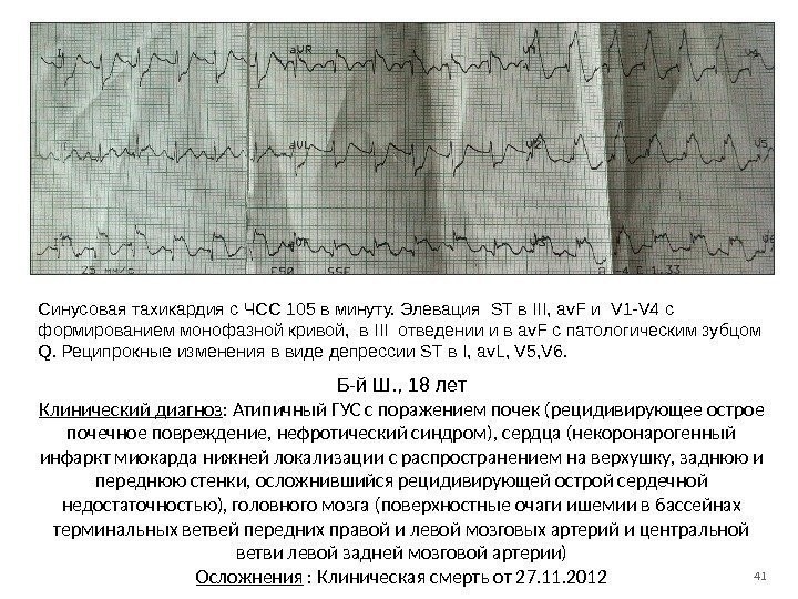 41 Синусовая тахикардия с ЧСС 105 в минуту. Элевация ST в III, av. F