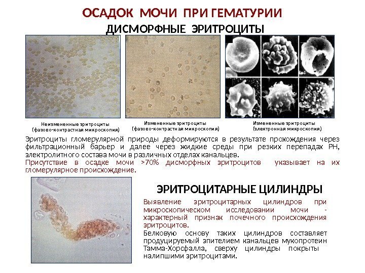 ОСАДОК МОЧИ ПРИ ГЕМАТУРИИ Выявление эритроцитарных цилиндров при микроскопическом исследовании мочи - характерный признак