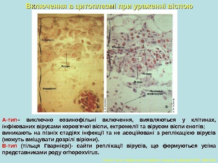 Включення в цитоплазмі при ураженні віспою A- тип – виключно еозинофільні включення,  виявляються