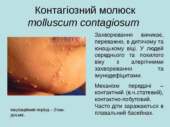 Контагіозний молюск molluscum contagiosum  Захворювання в иникає,  переважно, в дитячому та юнацькому